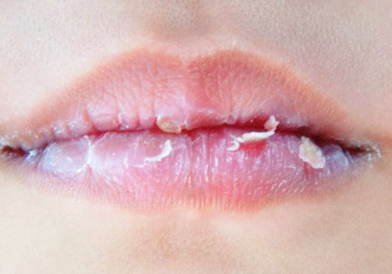 Tips Mengatasi Bibir Kering dan Mengelupas secara Alami Mudah Dilakukan
